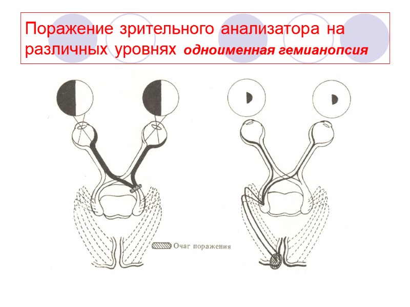 Поражение зрительного анализатора на различных уровнях одноименная гемианопсия